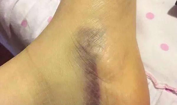 不正常淤青图片，身体无缘无故淤青是怎么回事（或许与这些原因有关系，别忽视）