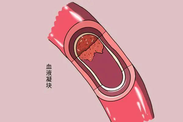 不正常淤青图片，身体无缘无故淤青是怎么回事（或许与这些原因有关系，别忽视）