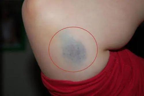 不正常淤青图片，身体无缘无故淤青是怎么回事（或许与这些原因有关系，别忽视）