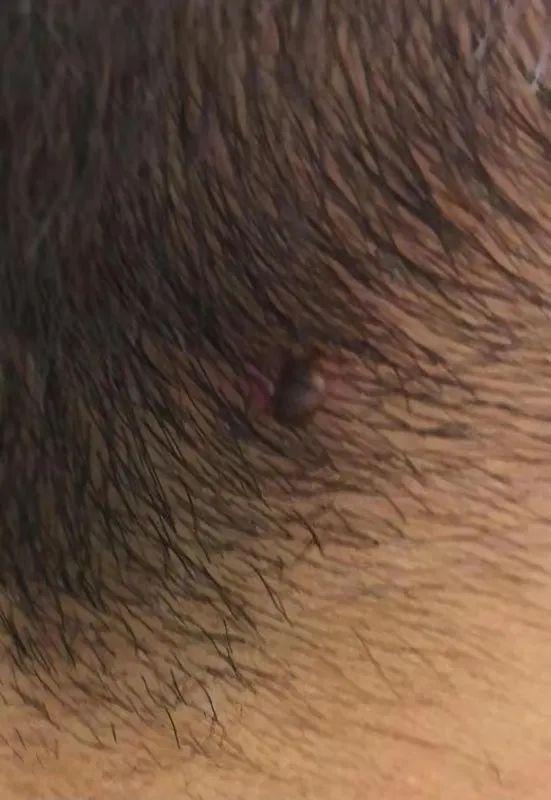 后脑勺长包图片，后脑勺长包是怎么回事（结果发现一个“黑点”）