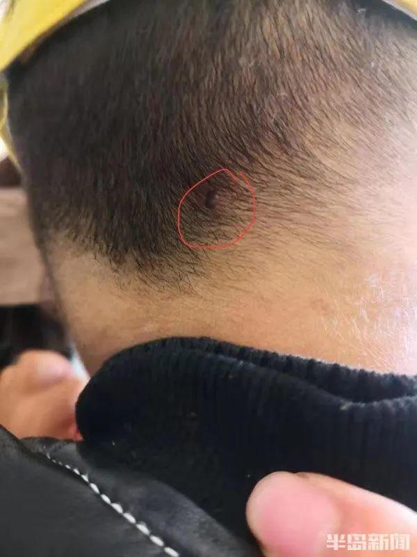 后脑勺长包图片，后脑勺长包是怎么回事（结果发现一个“黑点”）