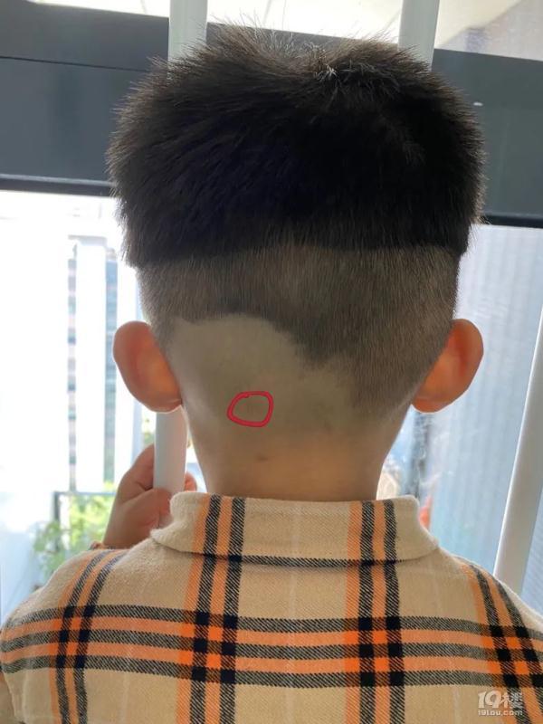 脖子后面长痘痘,脖子后面长痘痘是什么原因(孩子脖子后有颗粒状物)