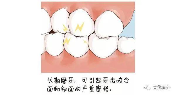 磨牙症的症状和危害，睡觉磨牙？你中招了吗