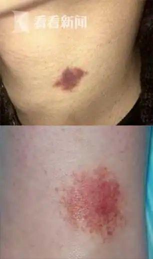 草莓印的危害是什么，草莓印有危害嘛（女友认定是吻痕要分手）