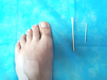 甲沟炎用什么药膏，甲沟炎怎么治疗才能彻底根除（得了甲沟炎怎么办）