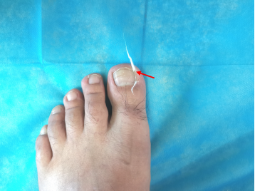 甲沟炎用什么药膏，甲沟炎怎么治疗才能彻底根除（得了甲沟炎怎么办）