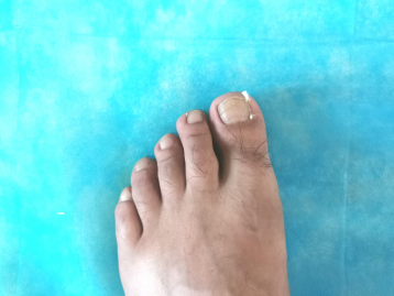 甲沟炎用什么药膏，甲沟炎怎么治疗才能彻底根除（得了甲沟炎怎么办）