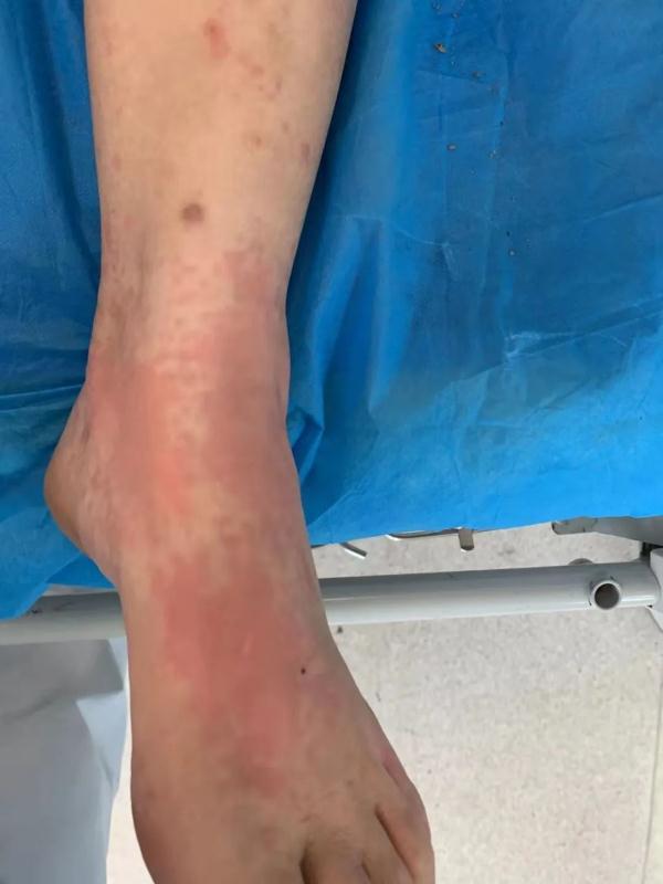 马蜂蛰了怎么处理,孩子被马蜂蛰了怎么处理(医生提醒