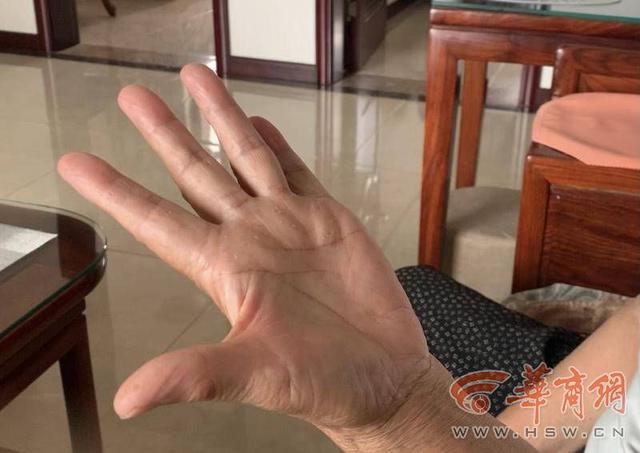佛手瓜要削皮吗，佛手瓜要去皮吗（西安七旬老人切了8个佛手瓜后手出现脱皮）