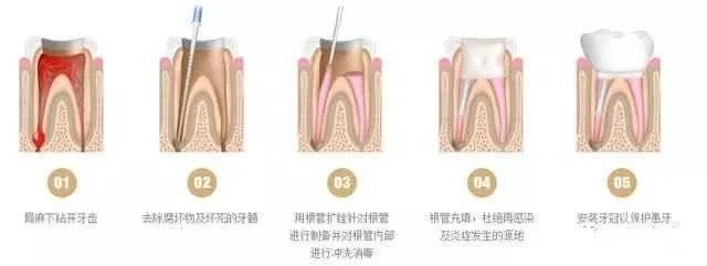 乳牙可以做根管治疗吗，乳牙可以做根管治疗吗,有什么影响没有（4岁宝宝被告知要做根管治疗）