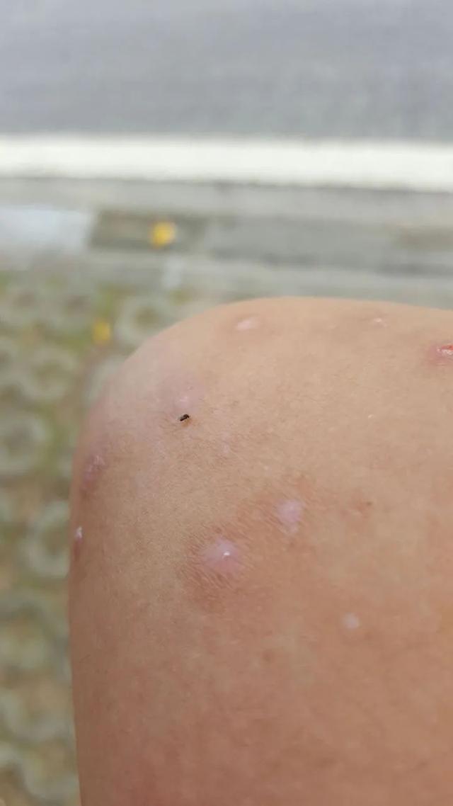 被蠓虫叮咬后,应立即涂抹花露水,风油精,还可以用酒精擦拭消毒.