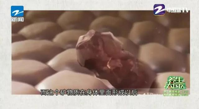 女性为什么会肾结石，女性为什么会得肾结石（医生劝告：4个诱因及时避开）