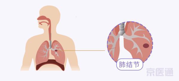 根号15等于多少，根号十五约等于多少（结节、肺炎、肺癌……5大肺病）