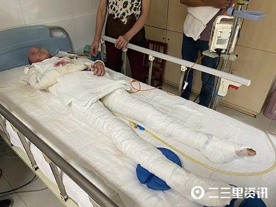 甲醇爆炸有毒吗，甲醇有爆炸性吗（全身90%被烧伤…孩子想继续跳舞）