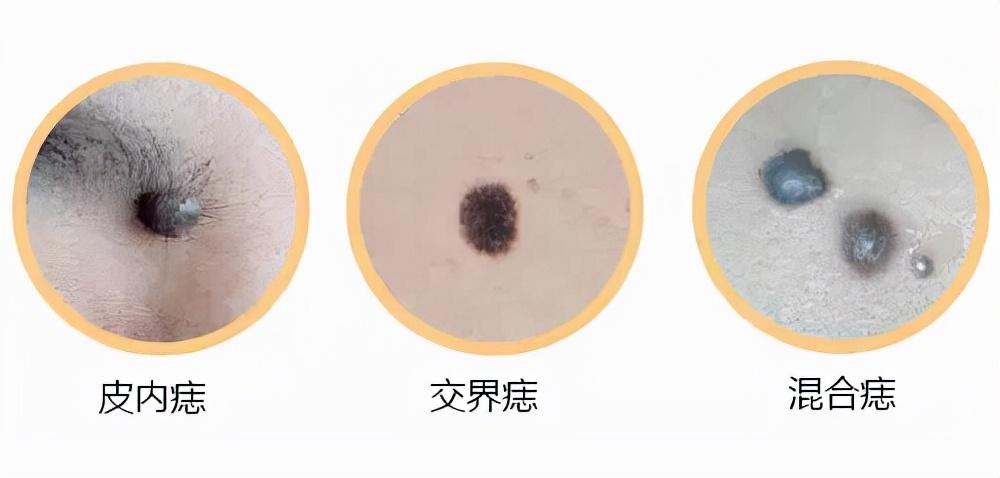 皮肤粘膜在皮肤的什么位置，皮肤粘膜在哪儿（长在8个部位的痣）