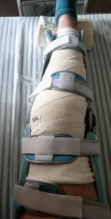 半月板损伤一辈子完蛋了，半月板损伤怎么治疗比较好得快（19岁的二断叉友都经历过什么）