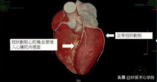 怎么看心肌桥严重程度，5分钟读懂心肌桥