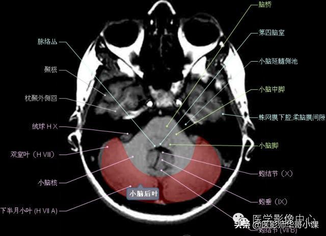 颅脑mri(头部MRI)插图(37)