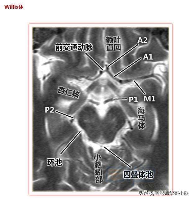 颅脑mri(头部MRI)插图(13)