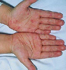 慢性肝炎能活几年，慢性乙肝（生命杀手之慢性乙型肝炎）