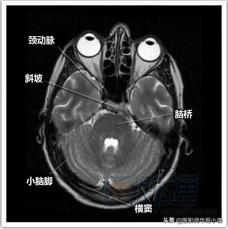 颅脑mri(头部MRI)插图(3)