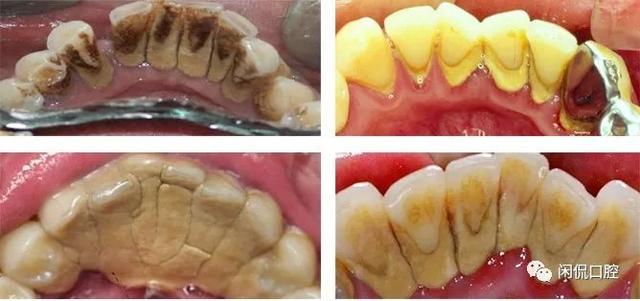 牙菌斑是什么，口腔白斑是什么病严重吗（牙菌斑和牙石）