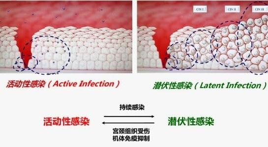 女性hpv感染真实图片，女性hpv真实图片早期（感染HPV，真的需要治疗吗）