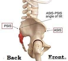 怎样判断自己骨盆前倾，骨盆前倾是怎么造成的肚子突出（小腹突出、臀部后凸）