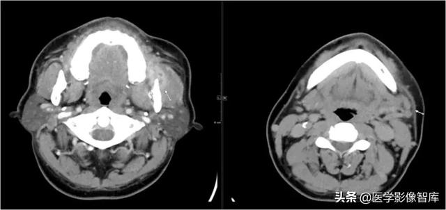 颞间隙感染，颞间隙感染切开部位（颌面部间隙感染影像诊断及各间隙解剖介绍）