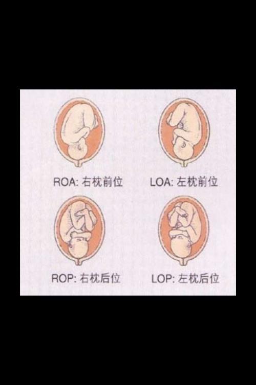 胎儿正枕前位示意图图片