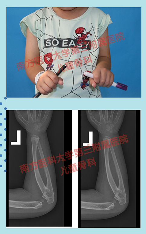 尺桡骨是哪里，先天性上尺桡关节融合