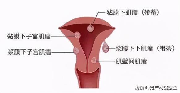 子宫粘膜下肌瘤，什么是粘膜下子宫肌瘤（发现子宫肌瘤怎么办）