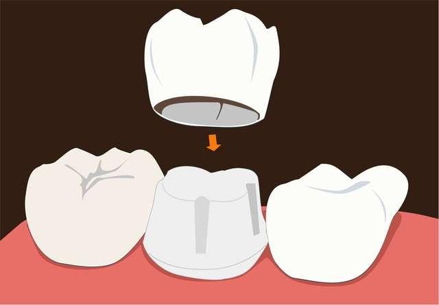 根管治疗后牙齿的寿命(牙冠多少钱一颗2022)插图(1)