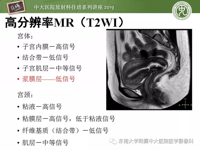 子宫颈影像解剖，子宫详细解剖及磁共振信号分析