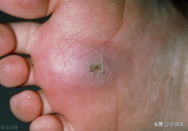 破伤风针多少钱，破伤风针多少钱一针在哪个部位打（15个实用医学小知识教你搞懂破伤风）