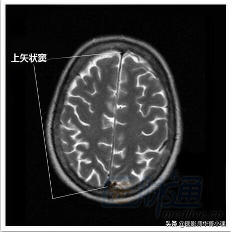 颅脑mri(头部MRI)插图(12)