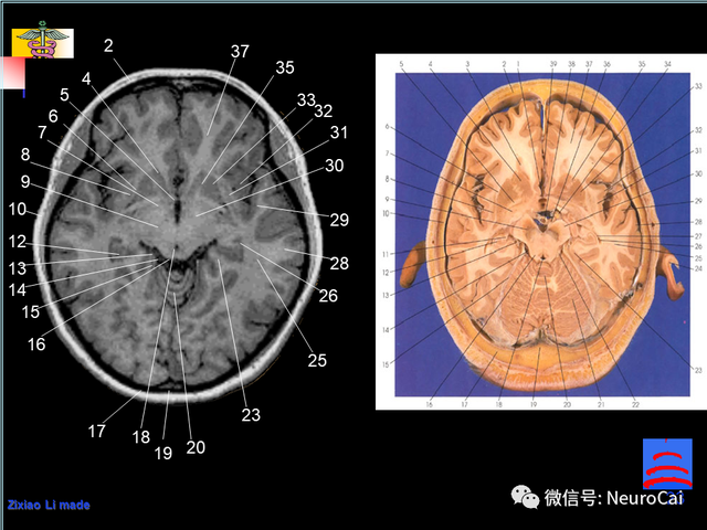 大脑结构图及功能图，人类大脑十大三维解剖图（脑局部解剖与功能图谱）