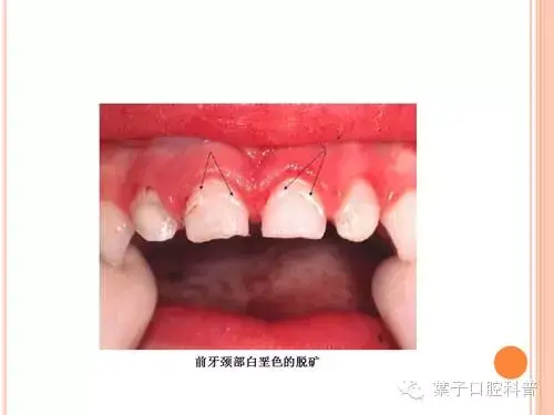 氟对牙齿的作用，含氟牙膏对牙齿的作用（有牙就要开始涂氟）