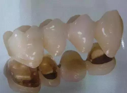 烤瓷牙是怎么做的，烤瓷牙是怎么做的伤牙吗（牙医教你如何选择烤瓷牙的材料）