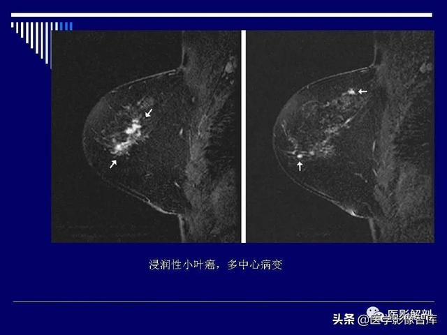 乳房解剖学基础知识，乳腺解剖及乳腺各病变影像诊断与鉴别