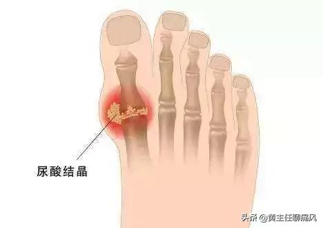 碳酸氢钠溶解度，碳酸氢钠和碳酸钠哪个溶解度高（两分一片的碳酸氢钠能降尿酸）