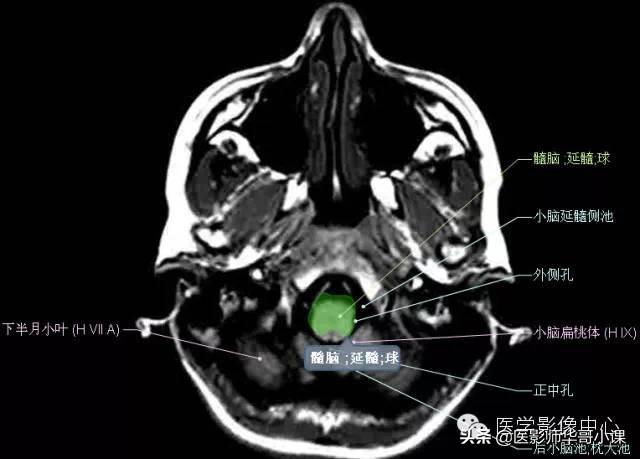 颅脑mri(头部MRI)插图(40)