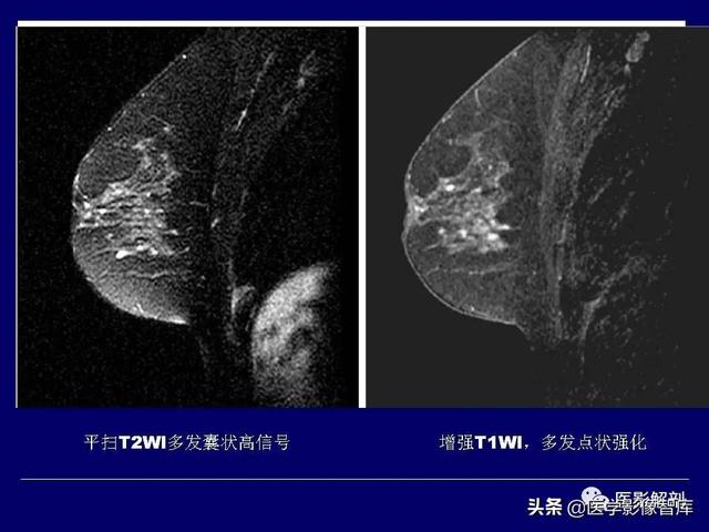 乳房解剖学基础知识，乳腺解剖及乳腺各病变影像诊断与鉴别