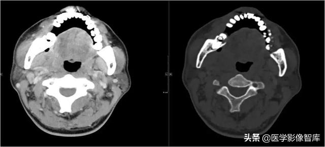 颞间隙感染，颞间隙感染切开部位（颌面部间隙感染影像诊断及各间隙解剖介绍）