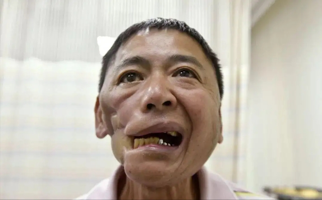 吃槟榔的舌头烂了图片图片