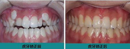 为什么会长虎牙，人为什么会长虎牙（长了会对其它牙齿有影响吗）