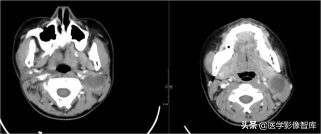 颞间隙感染，颞间隙感染切开部位（颌面部间隙感染影像诊断及各间隙解剖介绍）