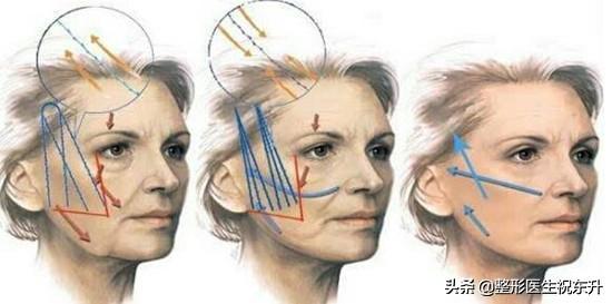 什么是面部线雕，什么是面部线雕（医生告诉您6个\