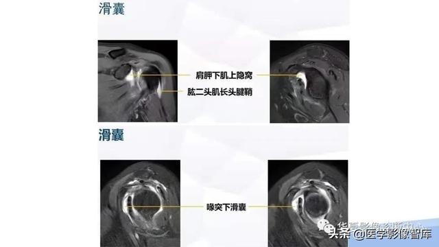 肩关节骨标志解剖图，全面掌握肩关节解剖