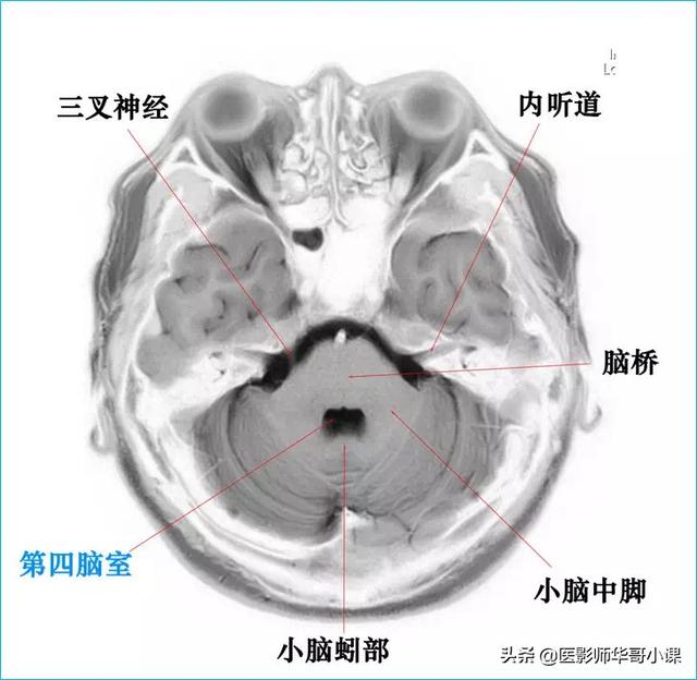 头颅ct解剖图，头部骨骼结构图（颅脑磁共振MRI解剖结构以及高清图谱）